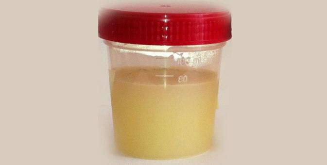 milky-white-urine