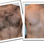 men-hair-chest-before-after