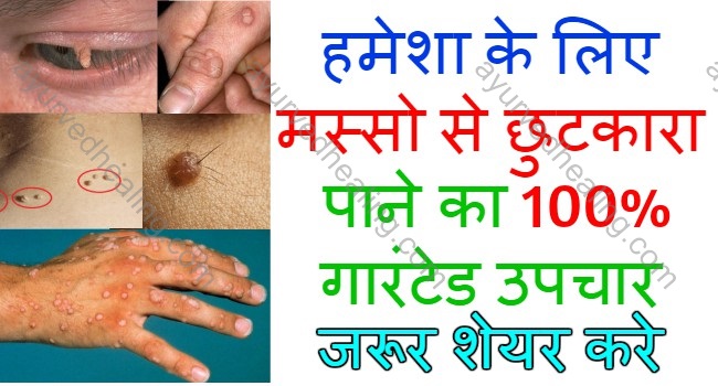 homeopathic-medicine-for-warts-in-hindi