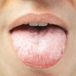 white-coated-tongue