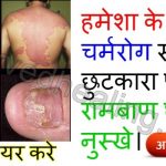 skin-diseases-home-remedies-in-hindi